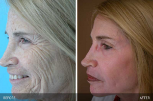 Skin-Tightening-Before-After-Photos