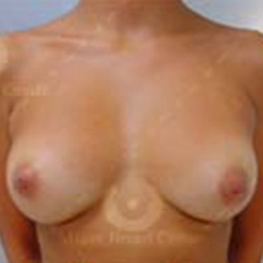 Natural Breast Augmentation Patient Temecula Ca Dr Kelly O Neil