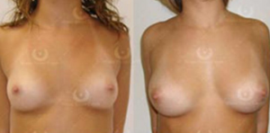 Natural Breast Augmenation by ONeil