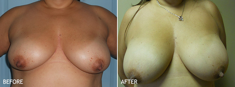 Before and after natural breast augmentation