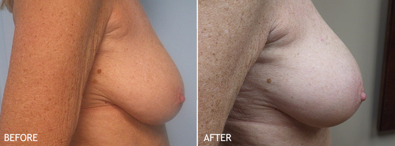 Before and after natural breast augmentation profile