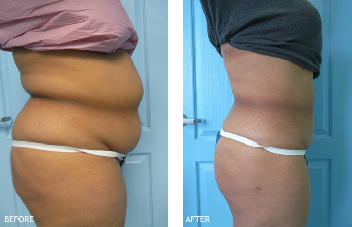 before and after liposculpture, Temecula, CA