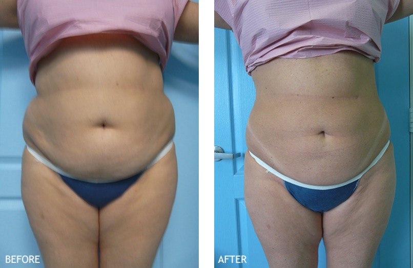 Before and after Non-Surgical Body Contouring - Temecula, CA